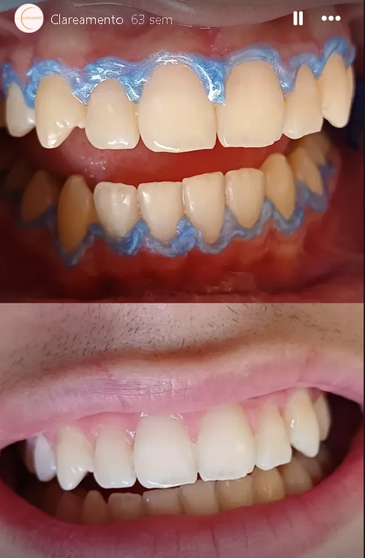 Resultado de clareamento dental