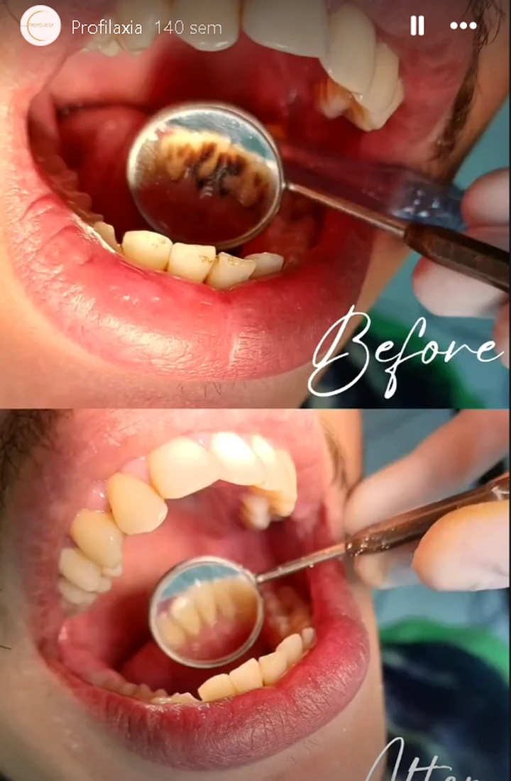 Resultado de profilaxia odontológica