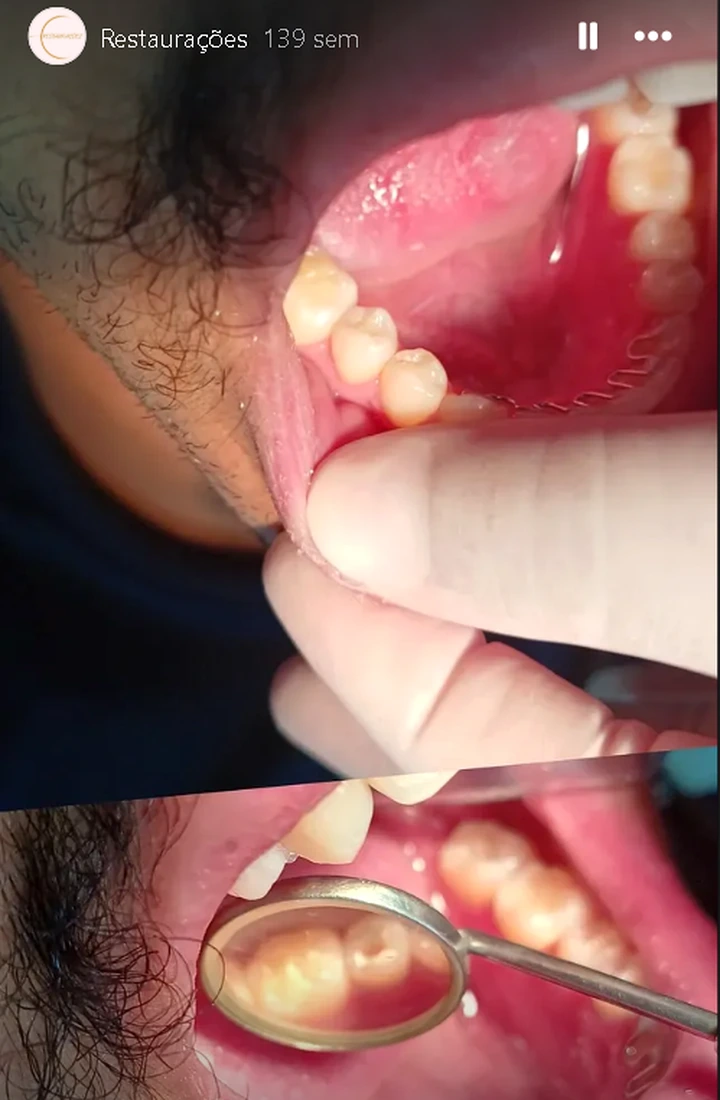 Resultado de restauração odontológica